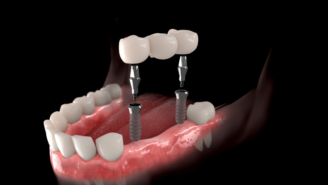 Implantes de carga inmediata